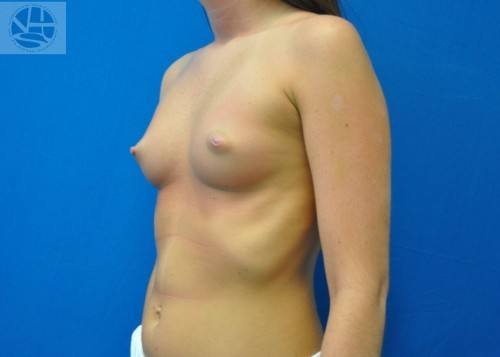 Breast Augmentation Before and After | Little Lipo