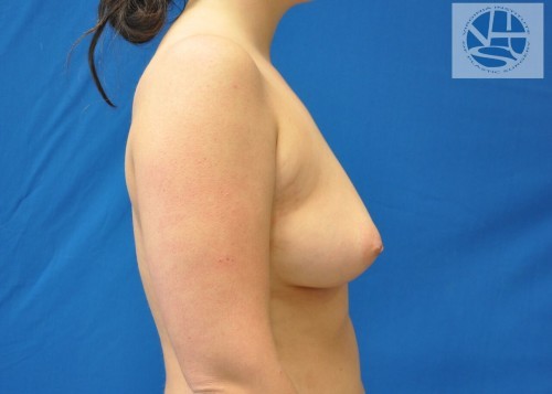 Breast Augmentation Before and After | Little Lipo