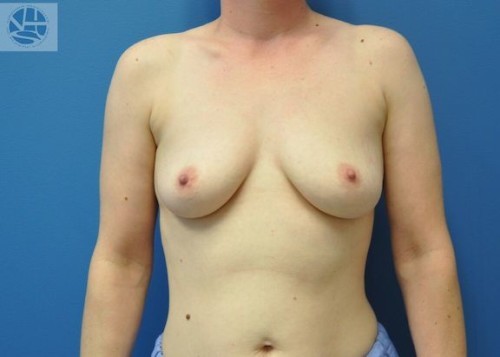 Breast Augmentation Before and After | Little Lipo