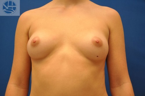Breast Augmentation Before and After | Little Lipo