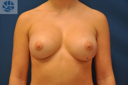 Breast Augmentation Before and After | Little Lipo