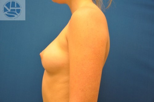 Breast Augmentation Before and After | Little Lipo
