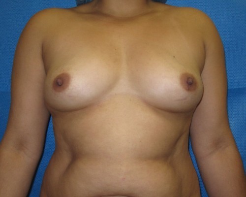 Breast Augmentation Before and After | Little Lipo