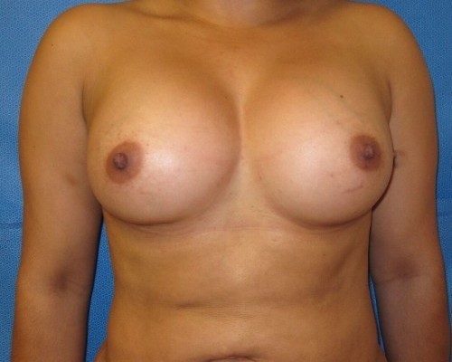 Breast Augmentation Before and After | Little Lipo