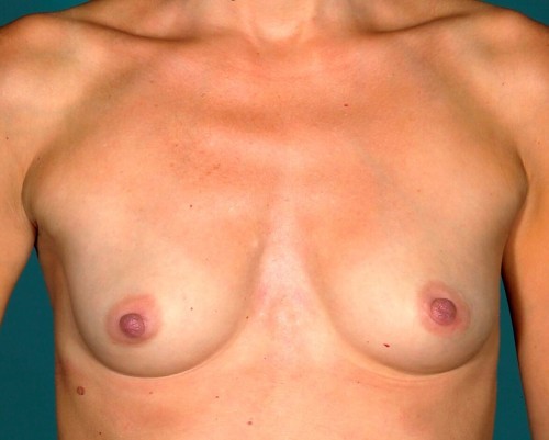 Breast Augmentation Before and After | Little Lipo