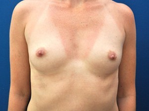 Breast Augmentation Before and After | Little Lipo