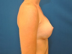 Breast Augmentation Before and After | Little Lipo