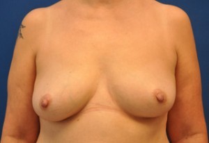 Breast Augmentation Before and After | Little Lipo