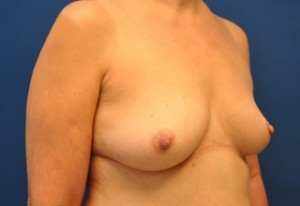 Breast Augmentation Before and After | Little Lipo