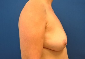 Breast Augmentation Before and After | Little Lipo