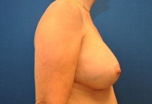 Breast Augmentation Before and After | Little Lipo