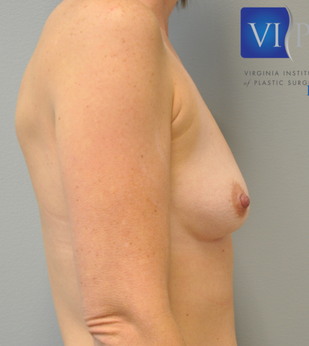 Breast Augmentation Before and After | Little Lipo