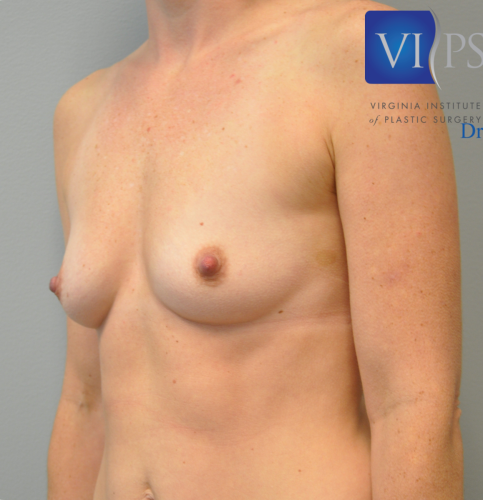 Breast Augmentation Before and After | Little Lipo