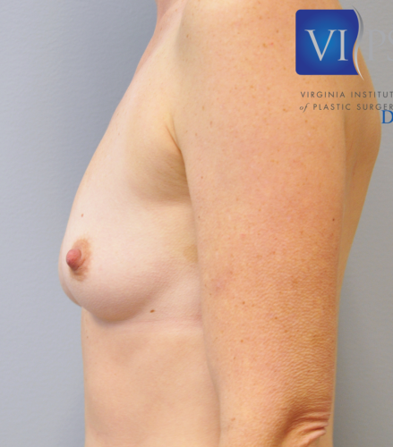 Breast Augmentation Before and After | Little Lipo
