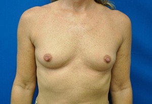 Breast Augmentation Before and After | Little Lipo