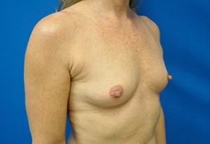 Breast Augmentation Before and After | Little Lipo