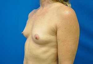 Breast Augmentation Before and After | Little Lipo