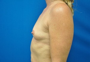 Breast Augmentation Before and After | Little Lipo