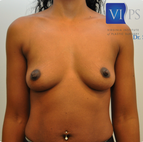 Breast Augmentation Before and After | Little Lipo