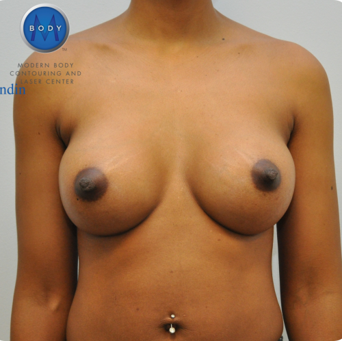 Breast Augmentation Before and After | Little Lipo