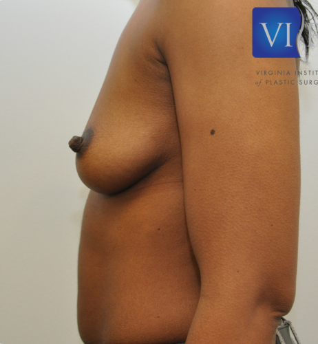 Breast Augmentation Before and After | Little Lipo