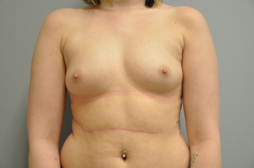 Breast Augmentation Before and After | Little Lipo