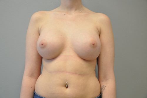 Breast Augmentation Before and After | Little Lipo