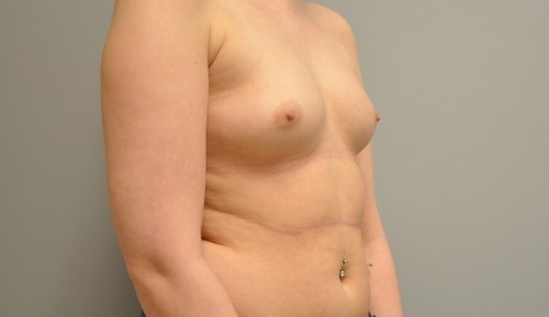 Breast Augmentation Before and After | Little Lipo