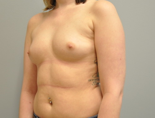 Breast Augmentation Before and After | Little Lipo