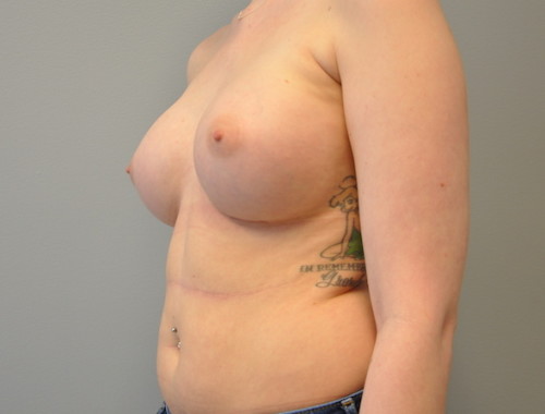 Breast Augmentation Before and After | Little Lipo