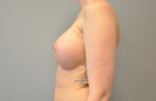 Breast Augmentation Before and After | Little Lipo