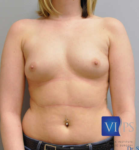 Breast Augmentation Before and After | Little Lipo