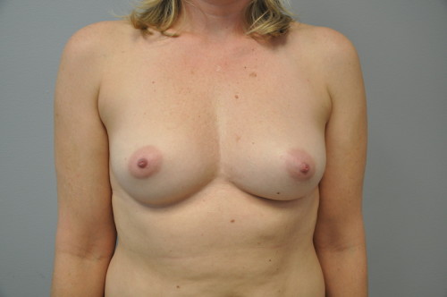 Breast Augmentation Before and After | Little Lipo