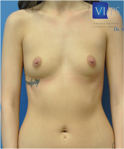 Breast Augmentation Before and After | Little Lipo