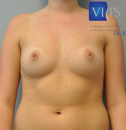 Breast Augmentation Before and After | Little Lipo