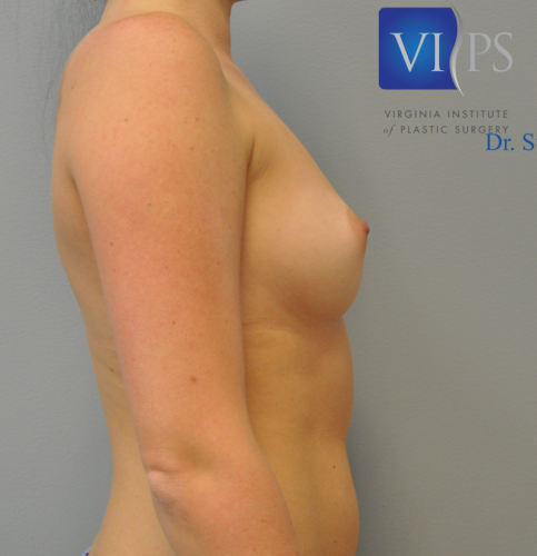 Breast Augmentation Before and After | Little Lipo