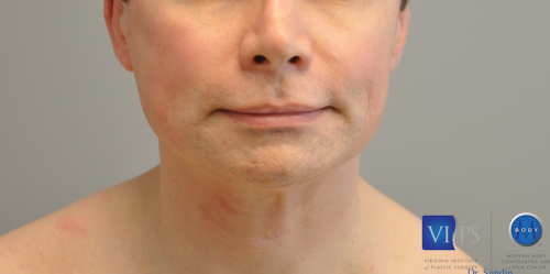 Chin Implant Before and After | Little Lipo