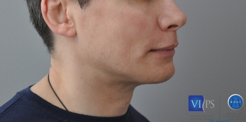 Chin Implant Before and After | Little Lipo