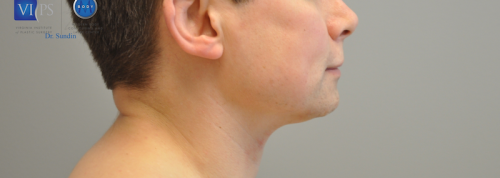 Chin Implant Before and After | Little Lipo