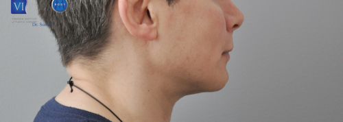 Chin Implant Before and After | Little Lipo