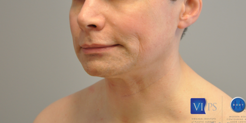 Chin Implant Before and After | Little Lipo