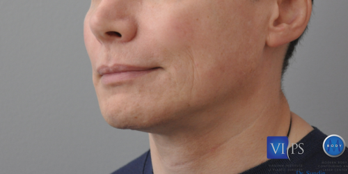 Chin Implant Before and After | Little Lipo