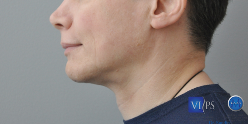 Chin Implant Before and After | Little Lipo