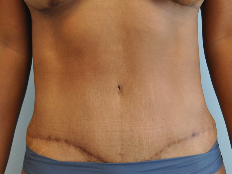 Co2 Laser Before and After | Little Lipo