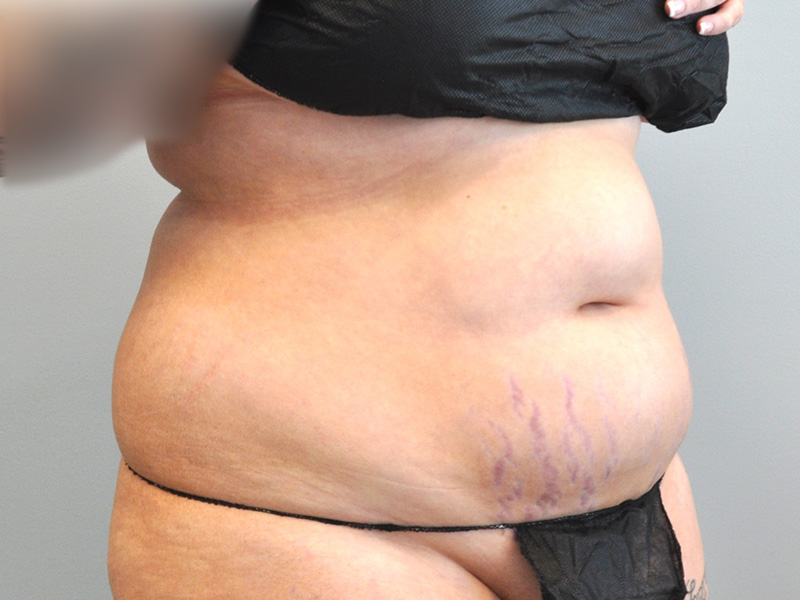 Co2 Laser Before and After | Little Lipo