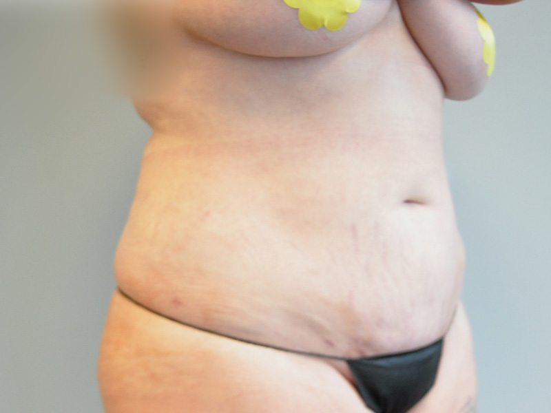 Co2 Laser Before and After | Little Lipo
