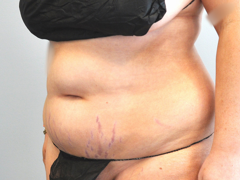 Co2 Laser Before and After | Little Lipo