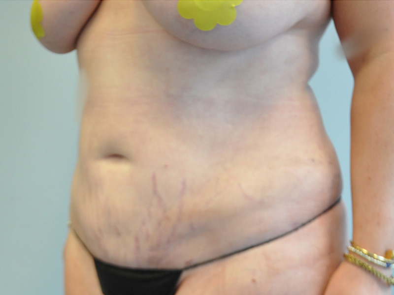Co2 Laser Before and After | Little Lipo