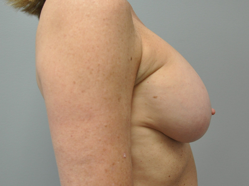 Co2 Laser Before and After | Little Lipo