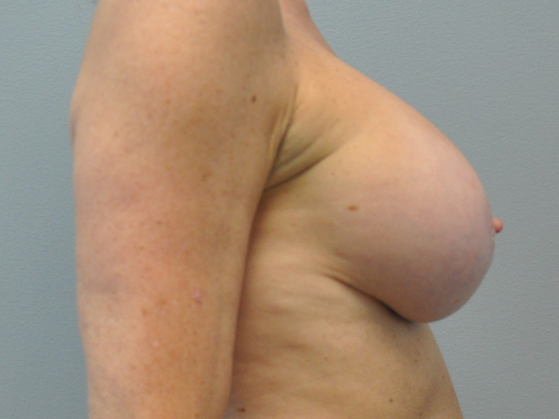 Co2 Laser Before and After | Little Lipo